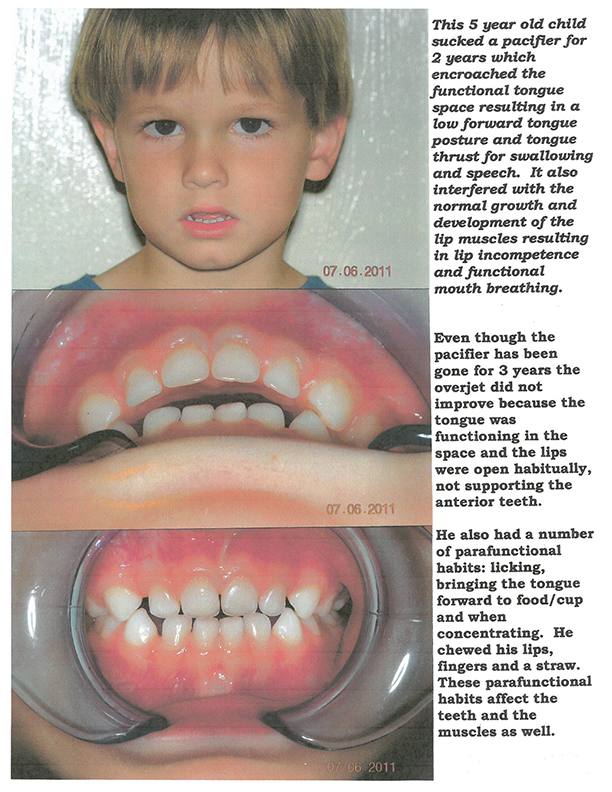 pacifier teeth in adults